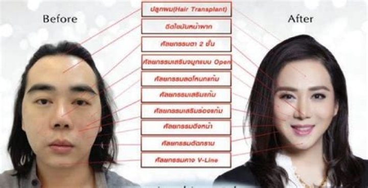 Anne Jakrajutatip Before Surgery
