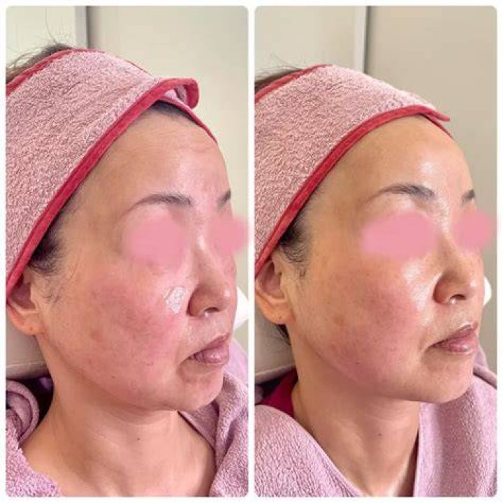 beforeafter