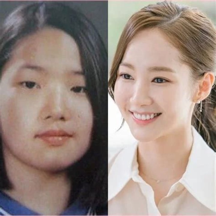 Choi Min-Young plastic surgery