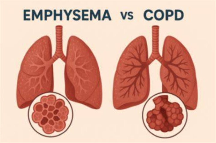 Is COPD the same thing as emphysema?