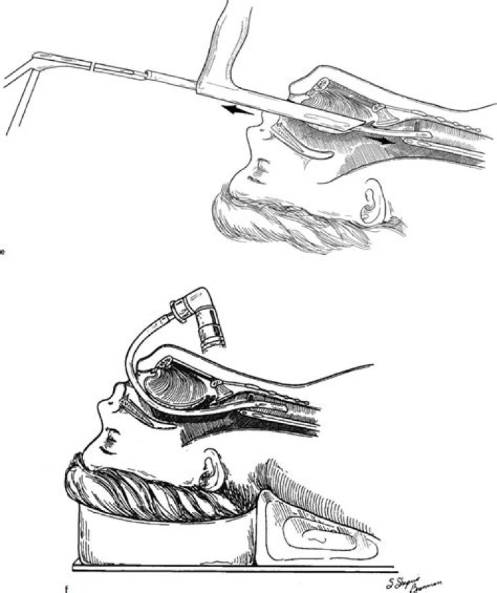 What is suspension Microlaryngoscopy?